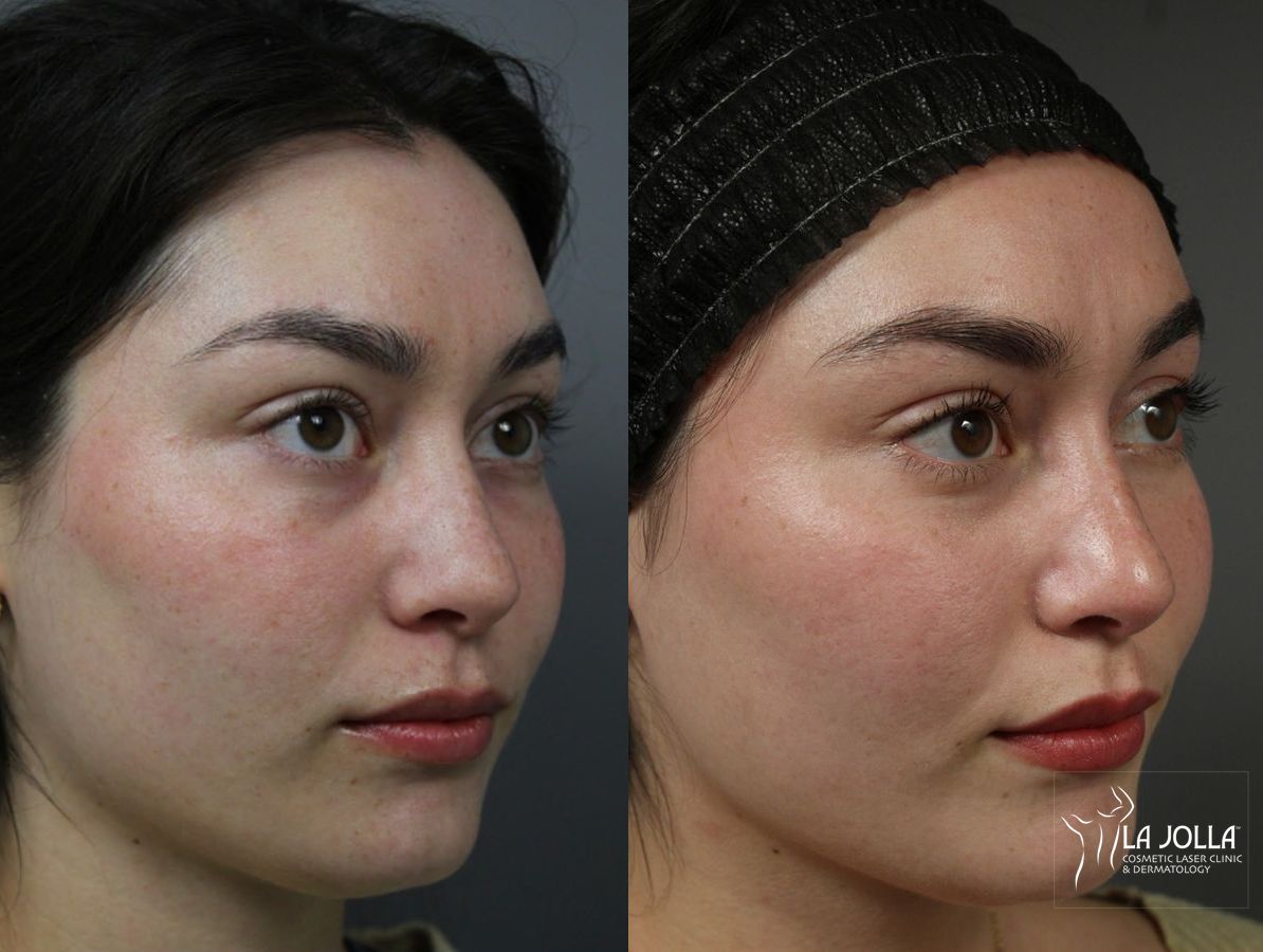 Before and after PRP Liquid Facelift case 36443 - Angle 2