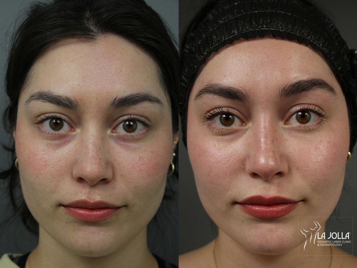 Before and after PRP Liquid Facelift case 36443