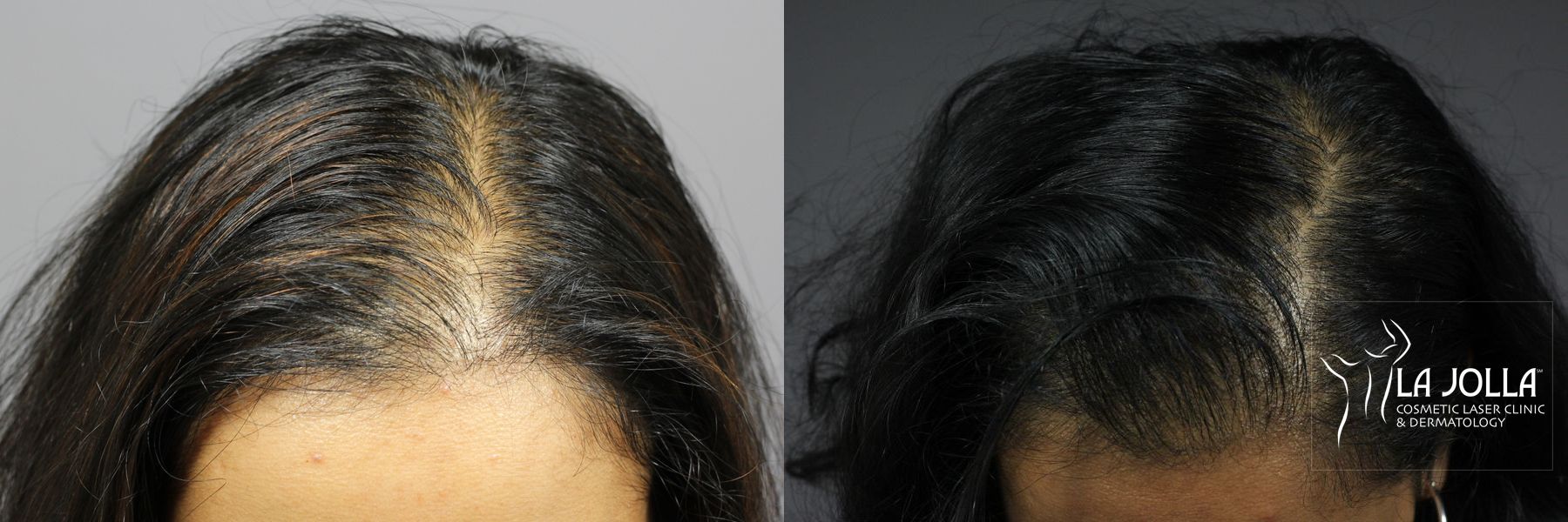 Before and after PRP (Platelet-Rich Plasma) case 36249