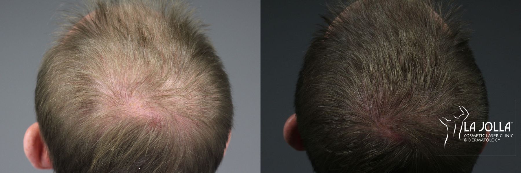 Before and after PRP (Platelet-Rich Plasma) case 36237 - Angle 2