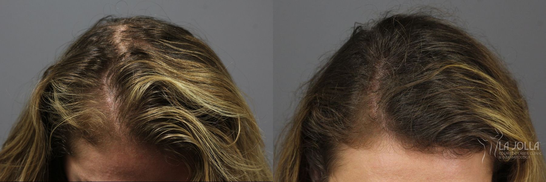 Before and after PRP (Platelet-Rich Plasma) case 36224