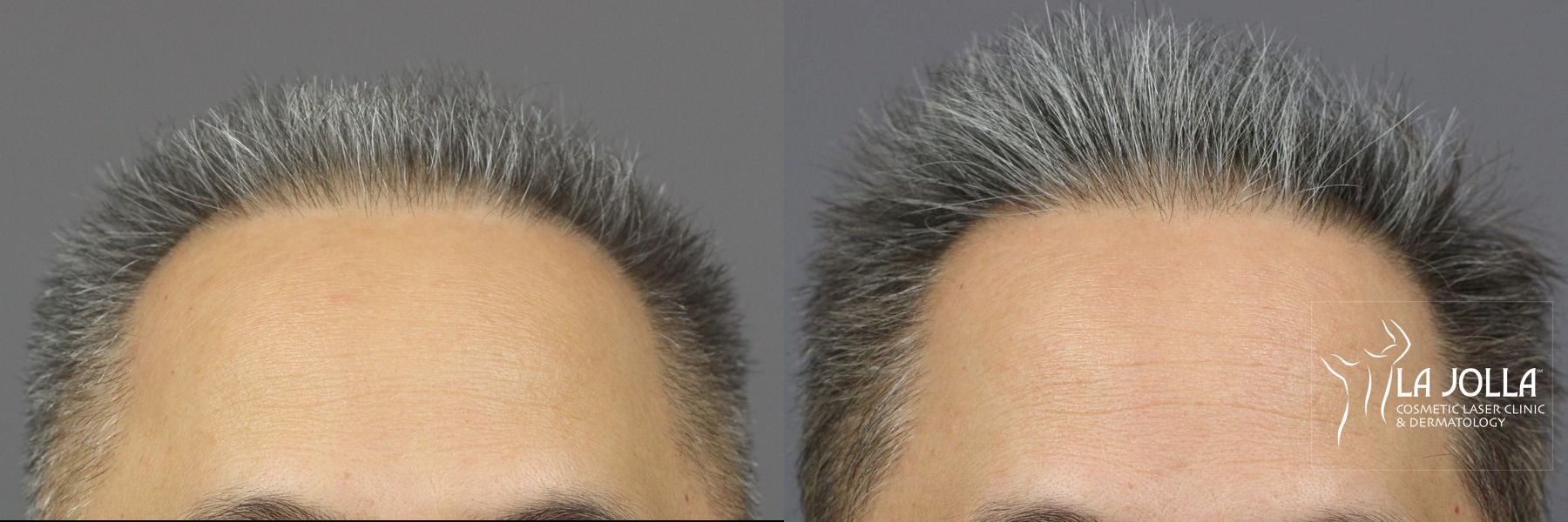 Before and after PRP (Platelet-Rich Plasma) case 36162 - Angle 2