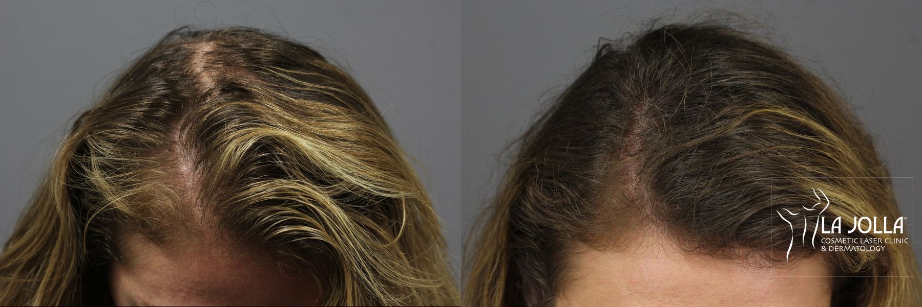 Before and after PRP (Platelet-Rich Plasma) case 36224