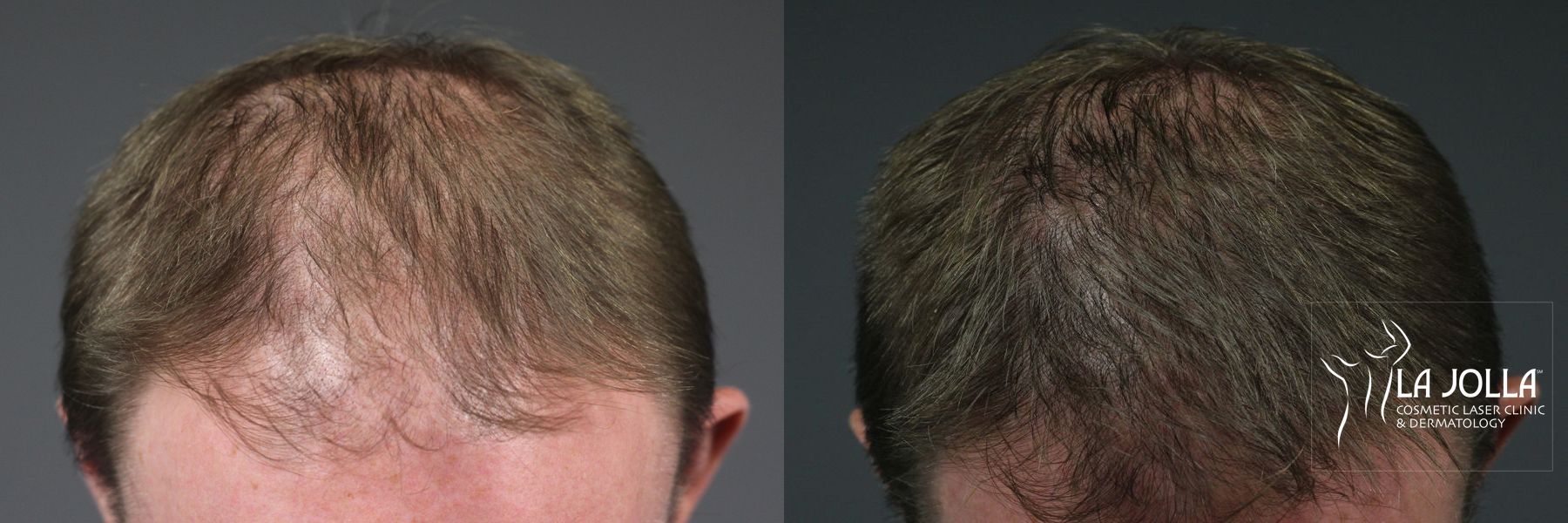 Before and after PRP (Platelet-Rich Plasma) case 36237