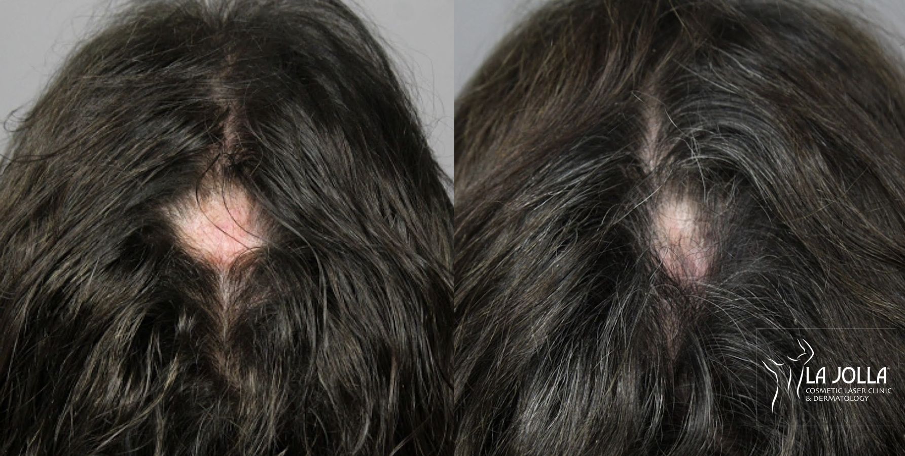 Before and after PRP (Platelet-Rich Plasma) case 36154 - Angle 2