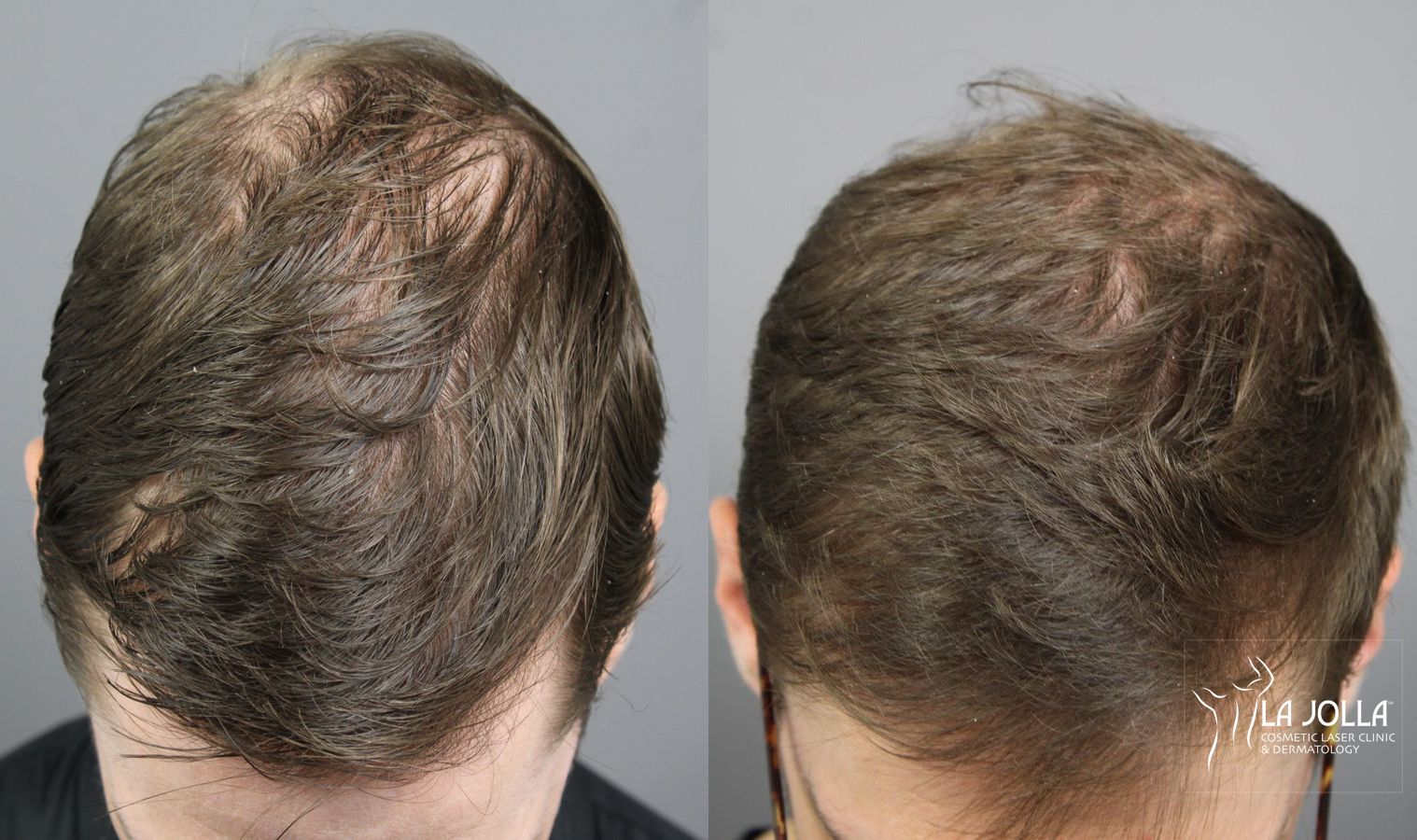 Before and after PRP (Platelet-Rich Plasma) case 36099