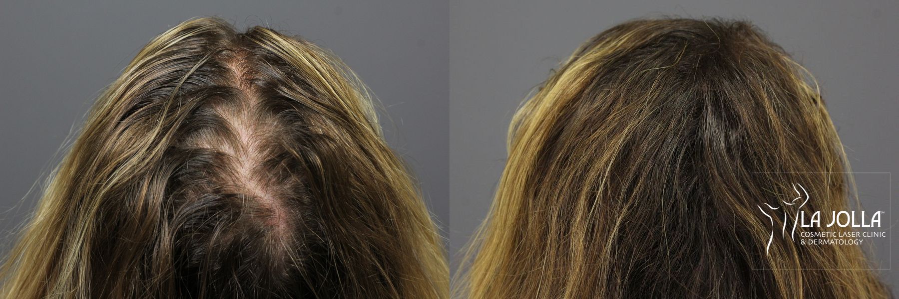 Before and after PRP (Platelet-Rich Plasma) case 36224 - Angle 4