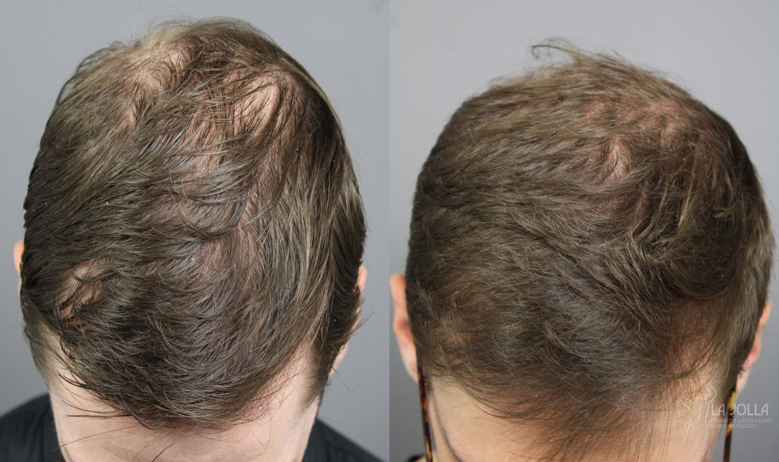 Before and after PRP (Platelet-Rich Plasma) case 36099