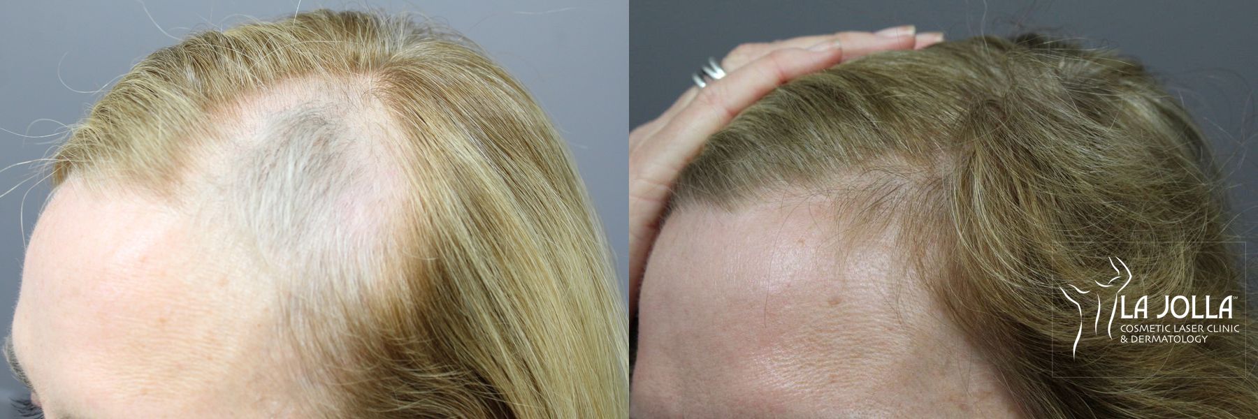 Before and after PRP (Platelet-Rich Plasma) case 36196