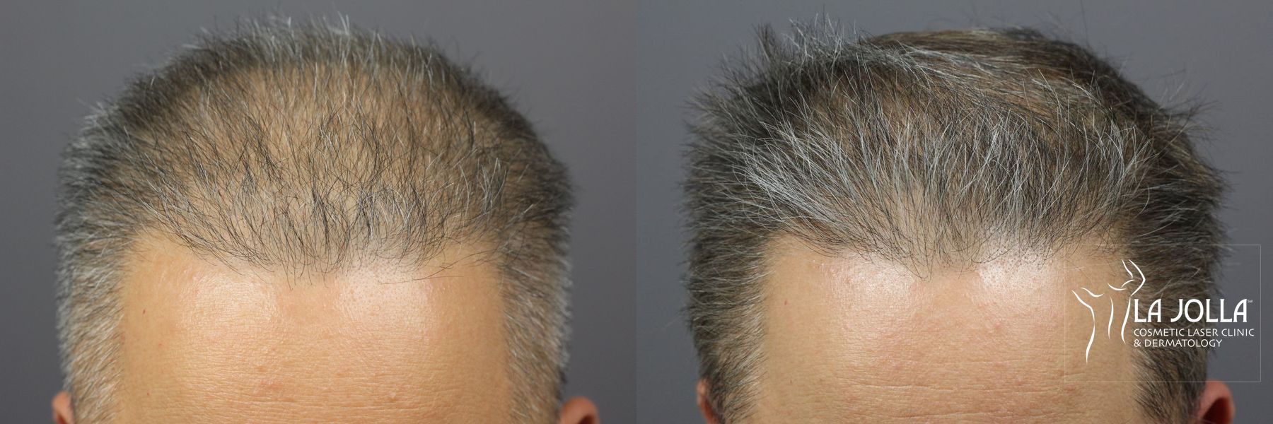 Before and after PRP (Platelet-Rich Plasma) case 36162