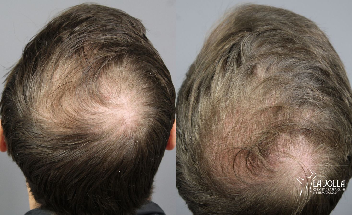 Before and after PRP (Platelet-Rich Plasma) case 36099 - Angle 2