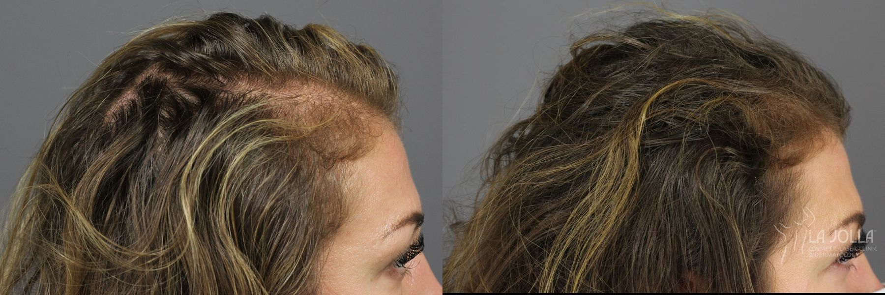 Before and after PRP (Platelet-Rich Plasma) case 36224 - Angle 3
