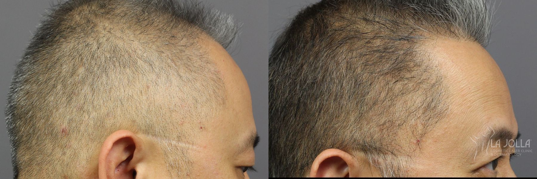 Before and after PRP (Platelet-Rich Plasma) case 36162 - Angle 3