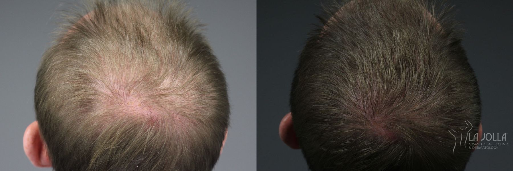 Before and after PRP (Platelet-Rich Plasma) case 36237 - Angle 2