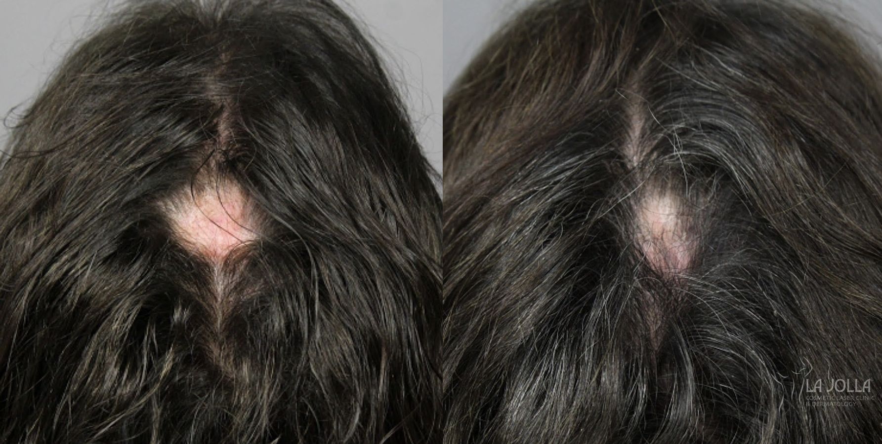 Before and after PRP (Platelet-Rich Plasma) case 36154 - Angle 2