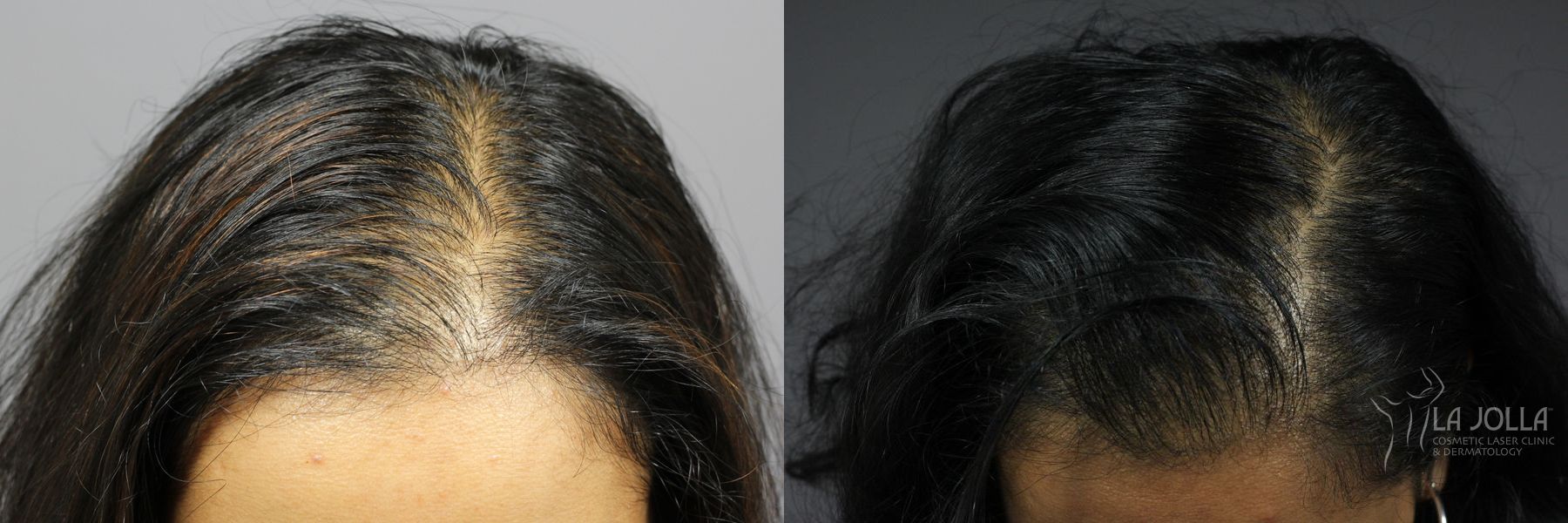 Before and after PRP (Platelet-Rich Plasma) case 36249