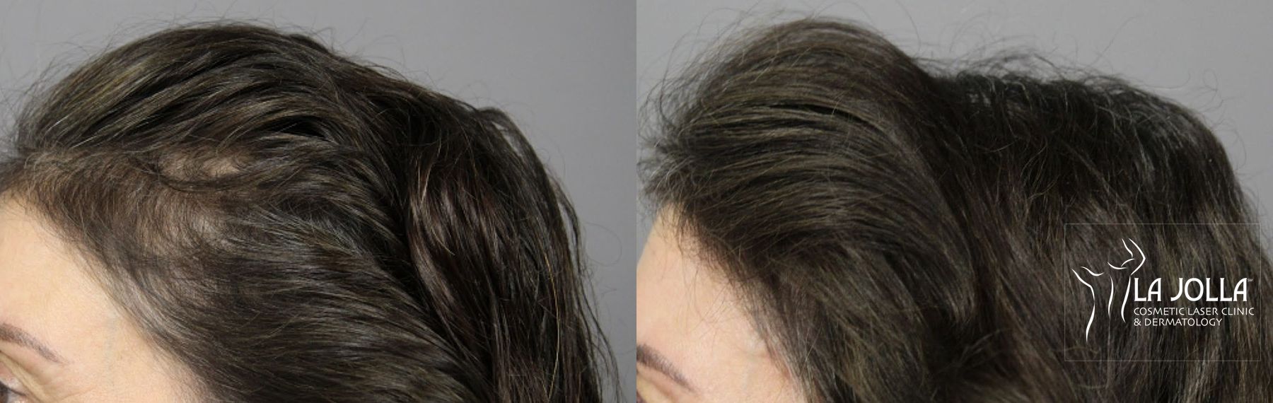 Before and after PRP (Platelet-Rich Plasma) case 36154