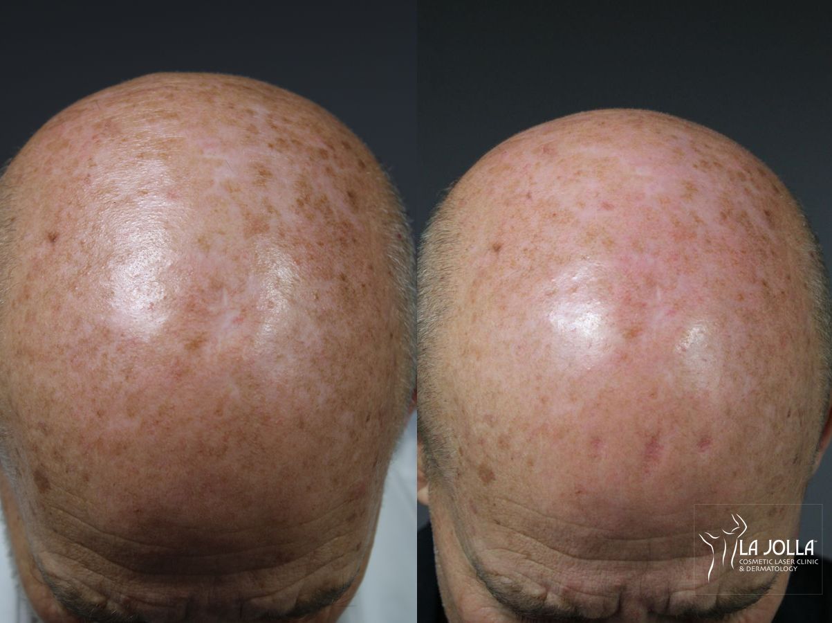 Before and after Radiesse® case 36086