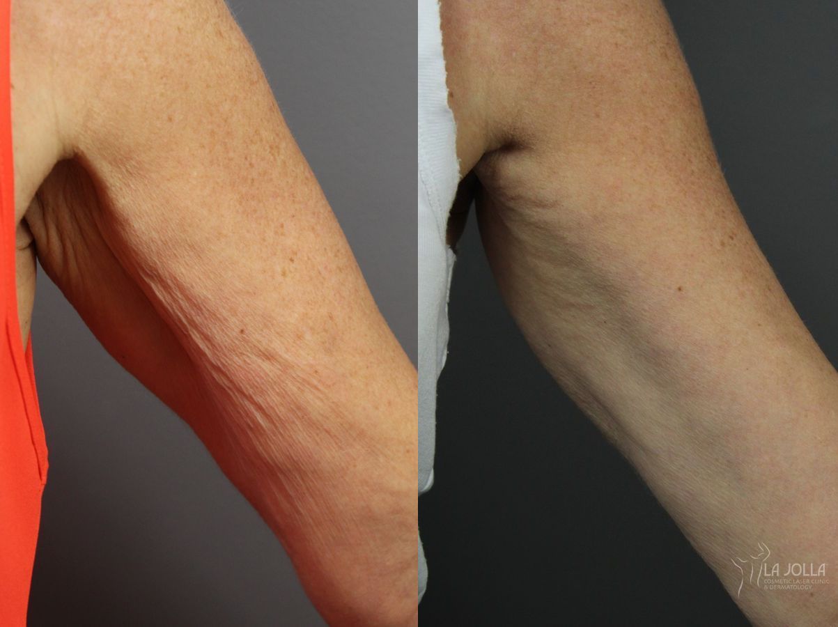 Before and after Radiesse® case 36134 - Angle 2