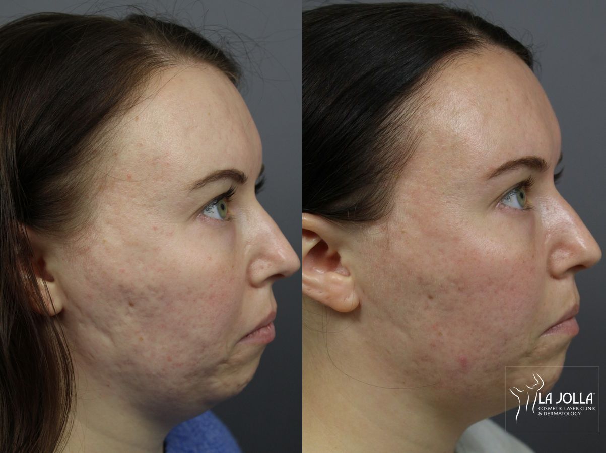 Before and after Radiesse® case 36095