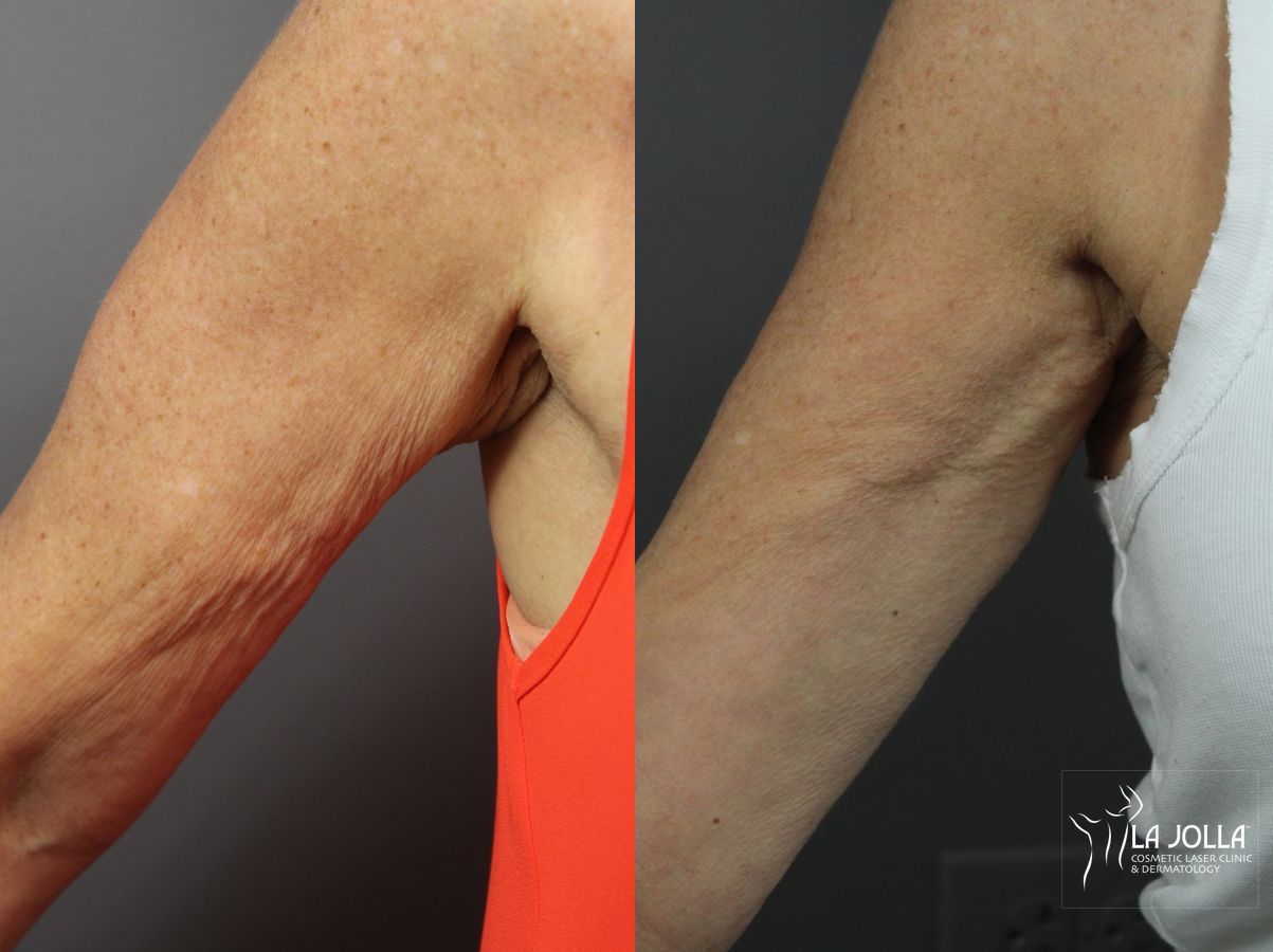 Before and after Radiesse® case 36134