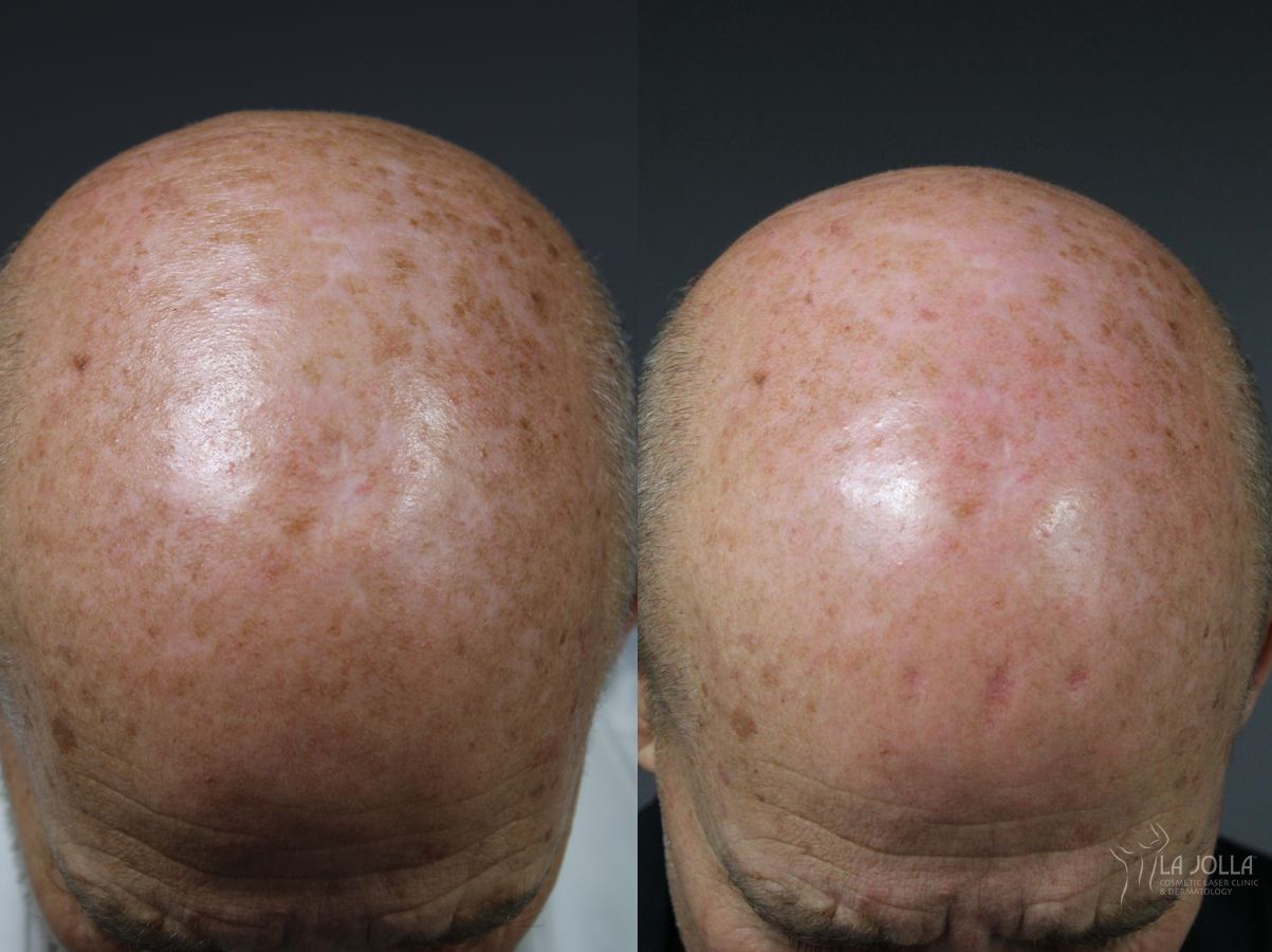 Before and after Radiesse® case 36086