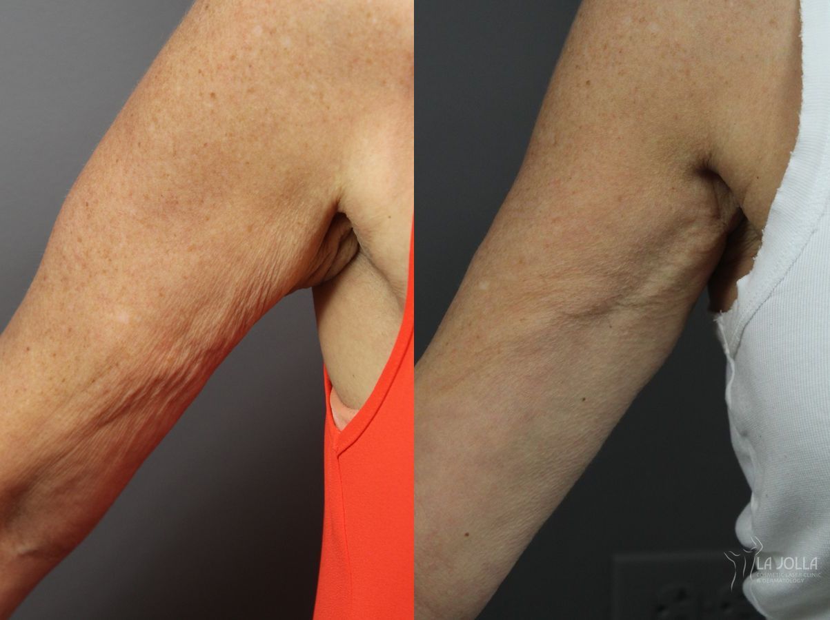 Before and after Radiesse® case 36134