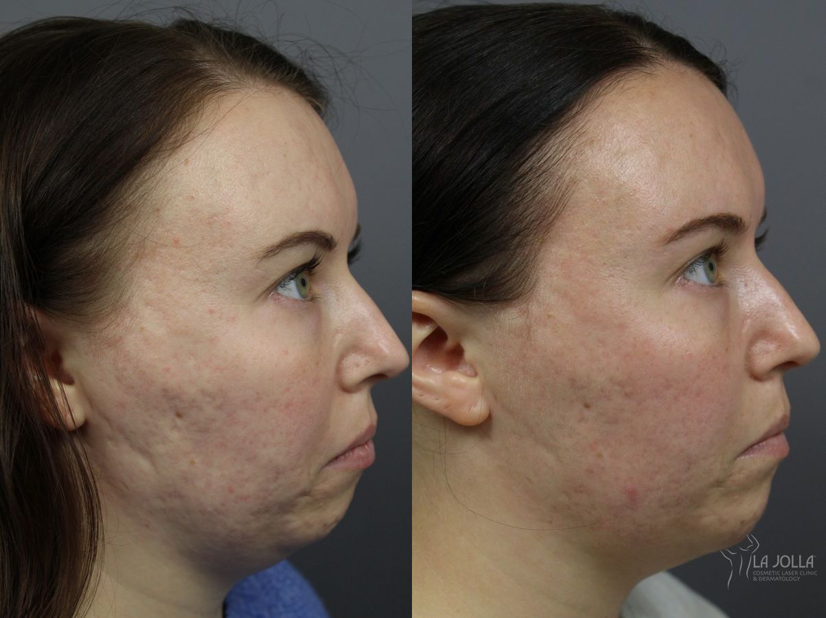Before and after Radiesse® case 36095
