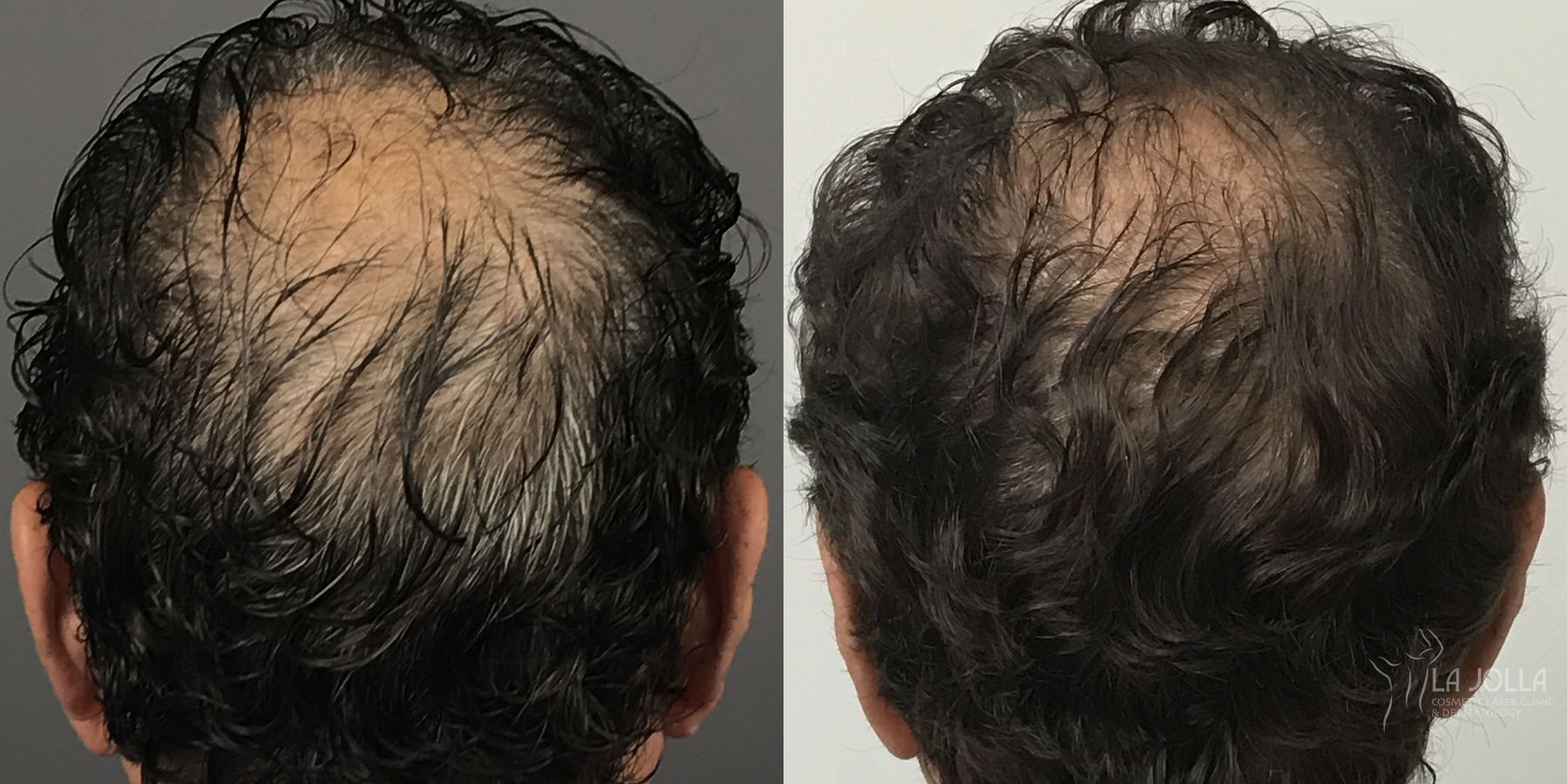 Before and after Regenerative Medicine case 36151