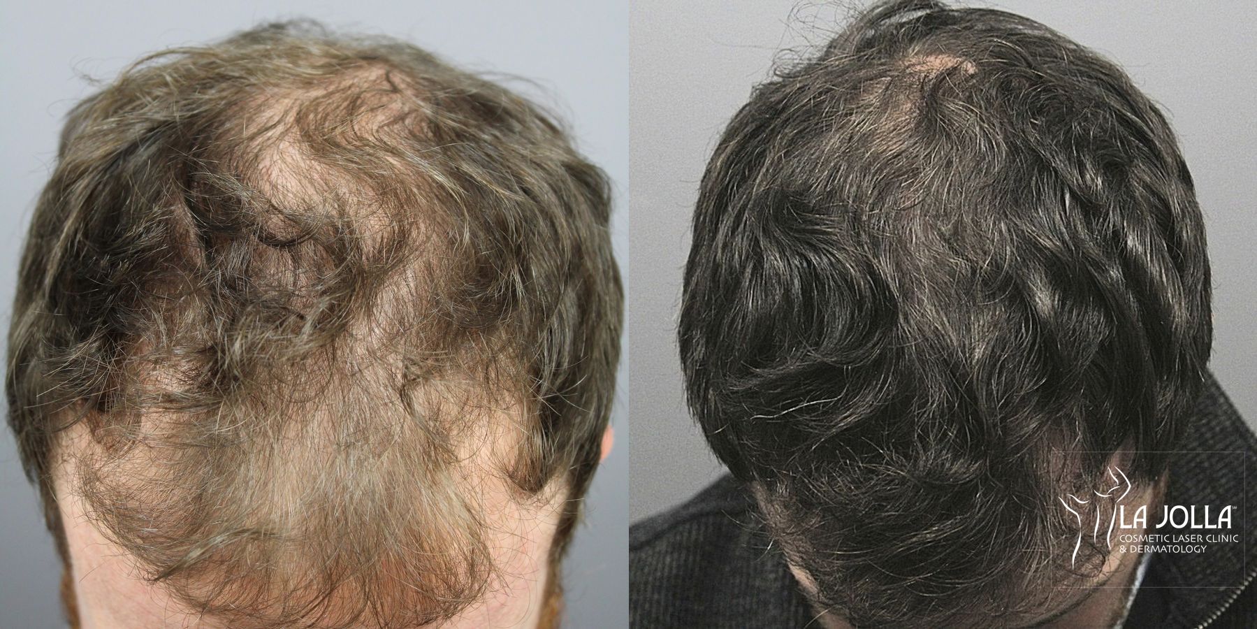 Before and after Regenerative Medicine case 36125