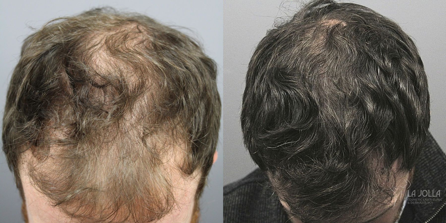 Before and after Regenerative Medicine case 36125