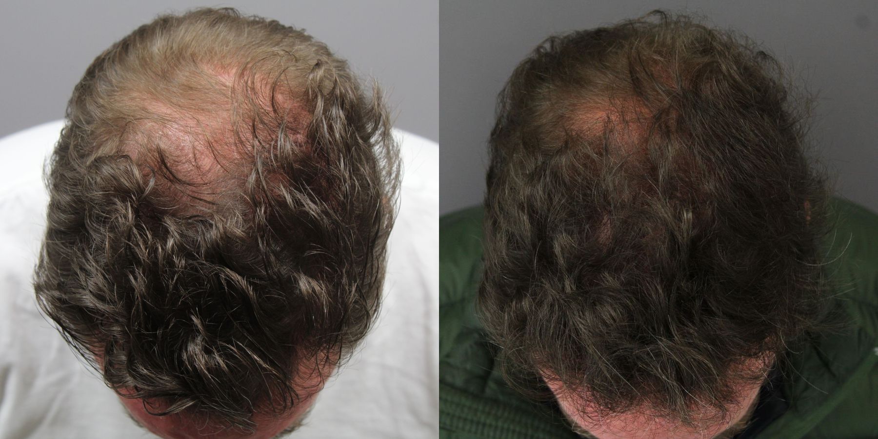Before and after Regenerative Medicine case 36210