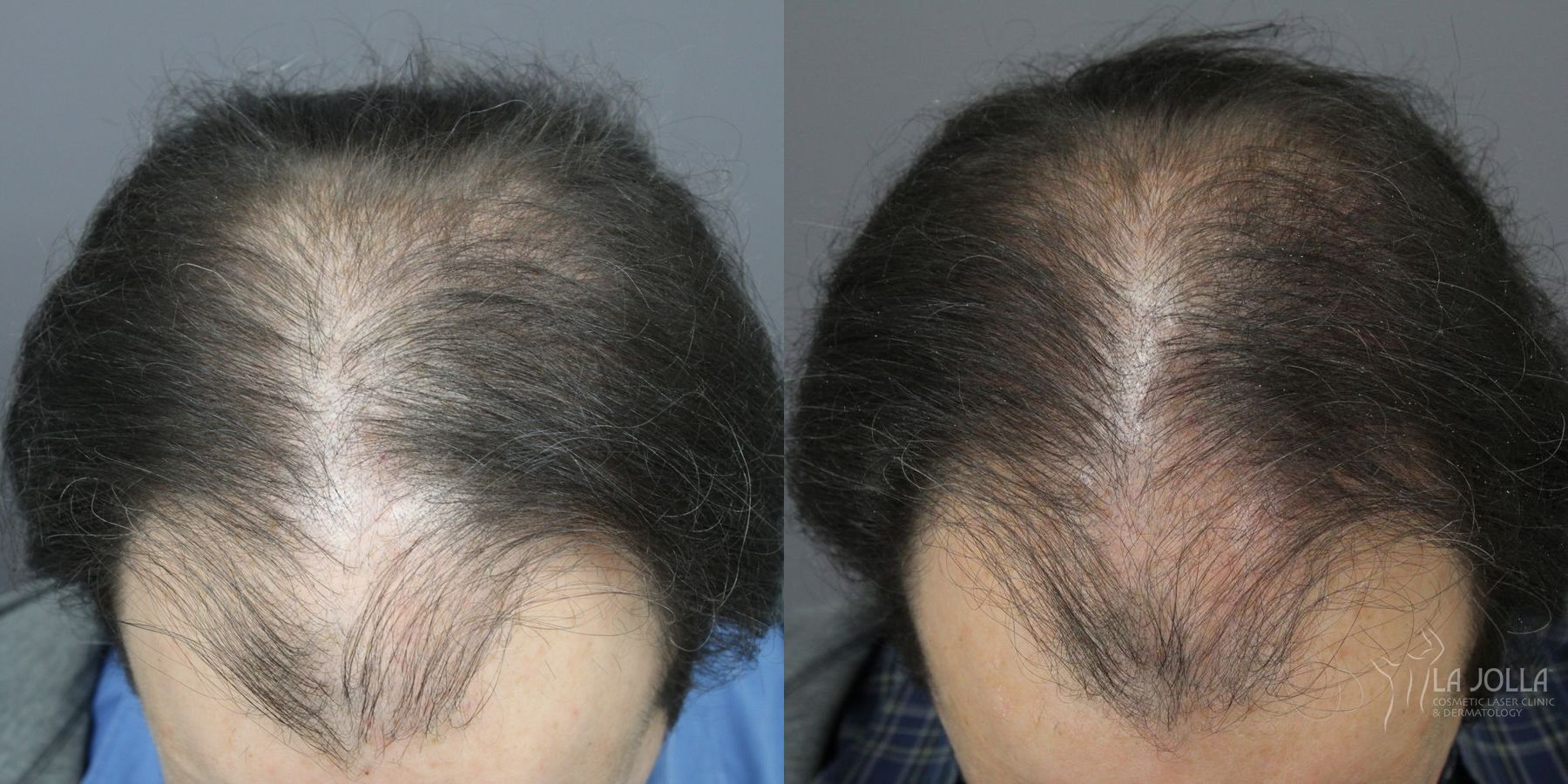Before and after Regenerative Medicine case 36173