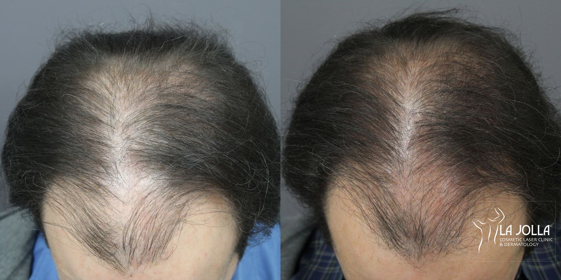 Before and after Regenerative Medicine case 36173