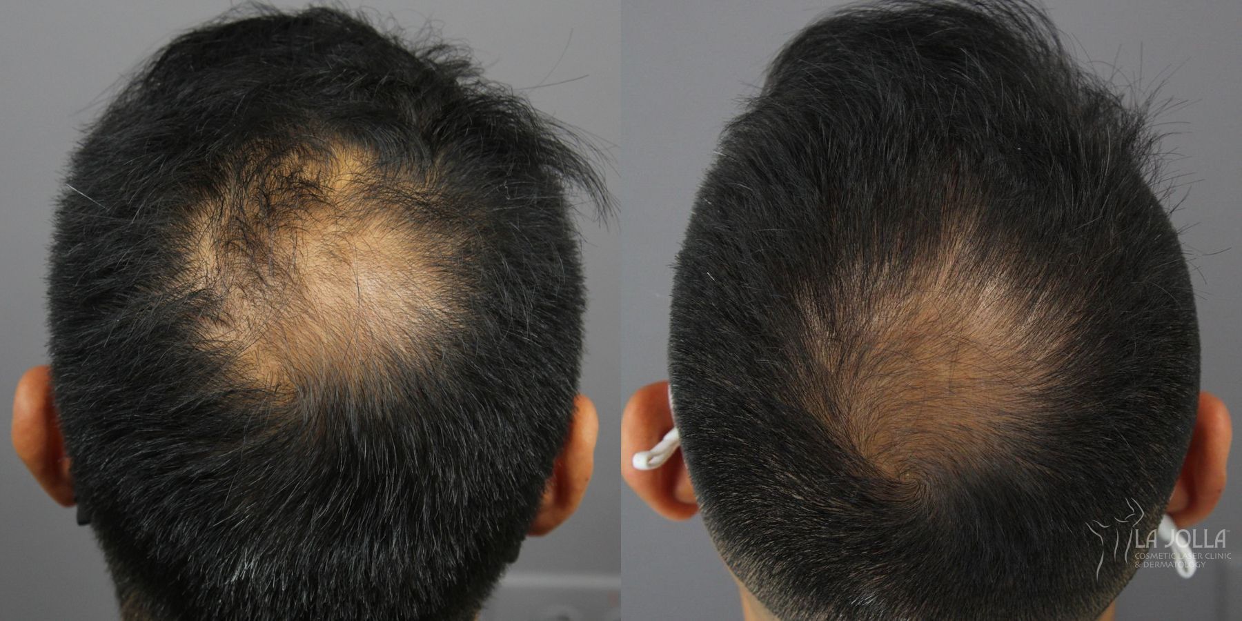 Before and after Regenerative Medicine case 36240