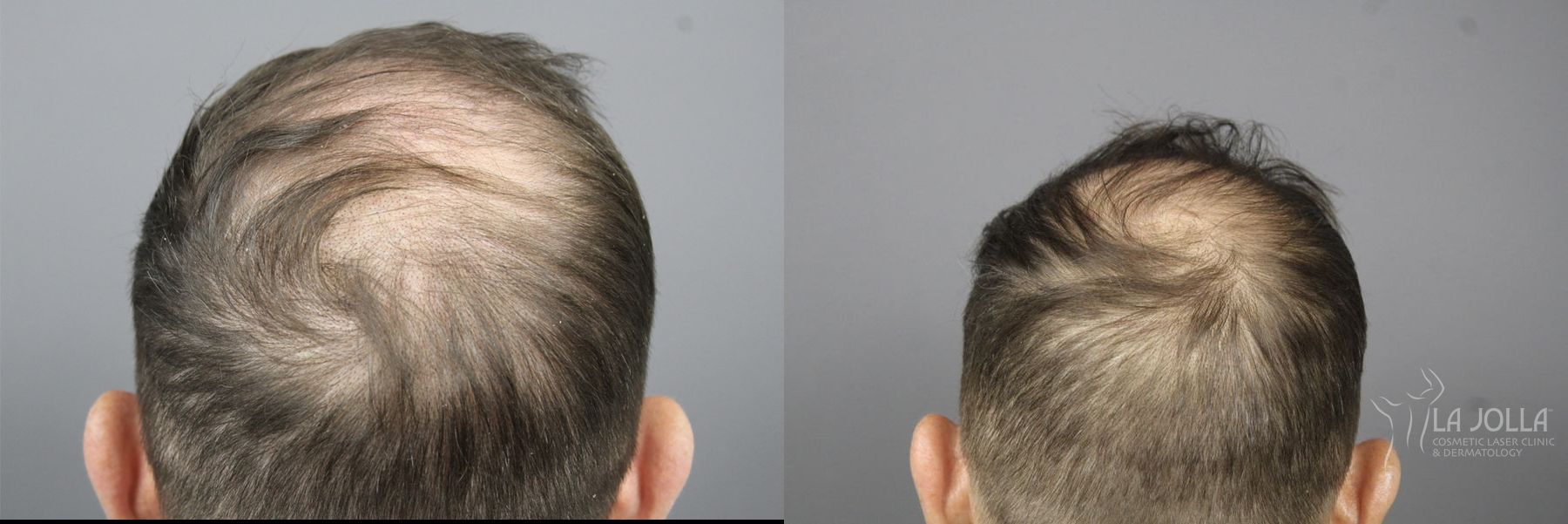 Before and after Regenerative Medicine case 36106