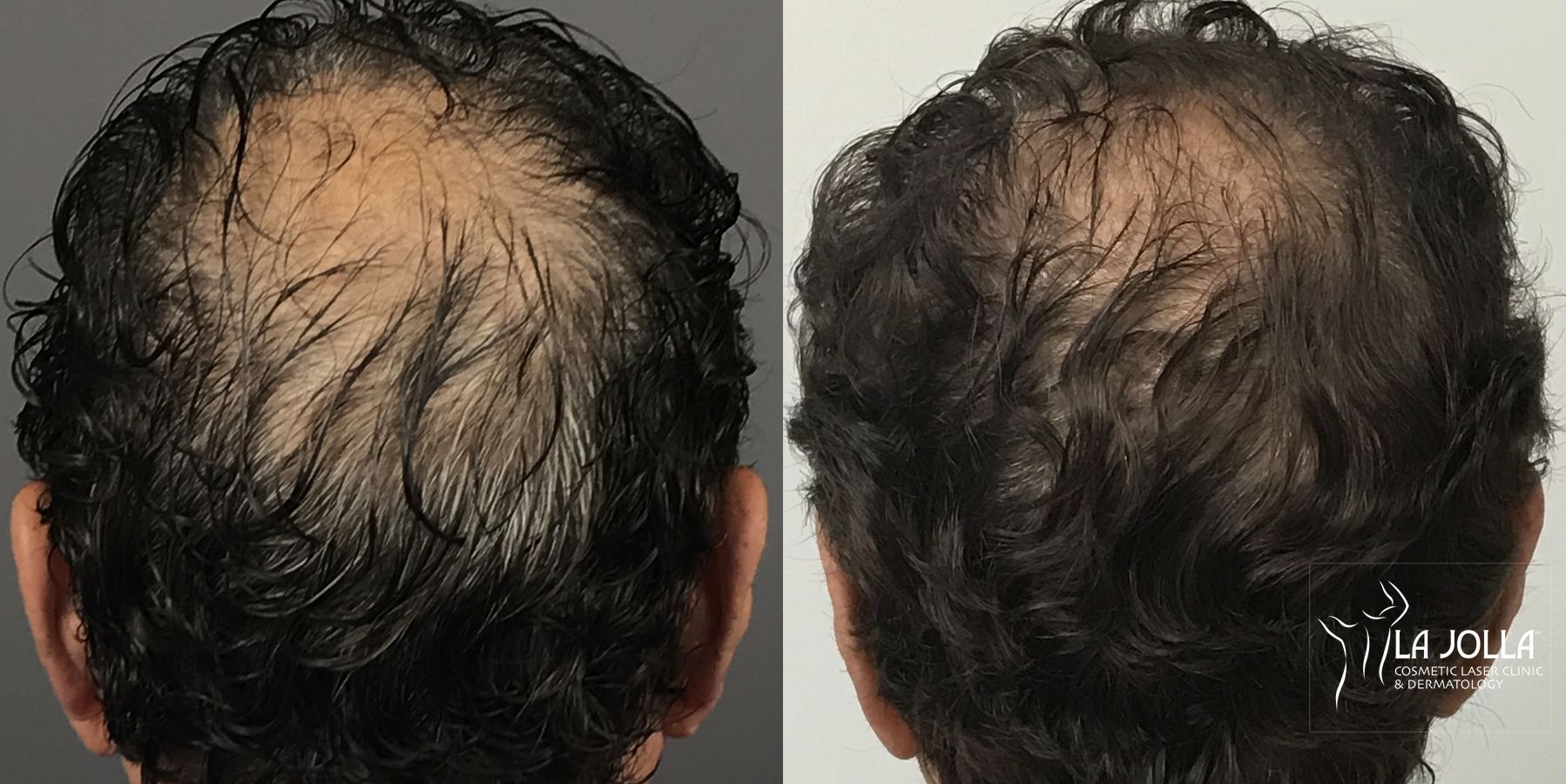 Before and after Regenerative Medicine case 36151