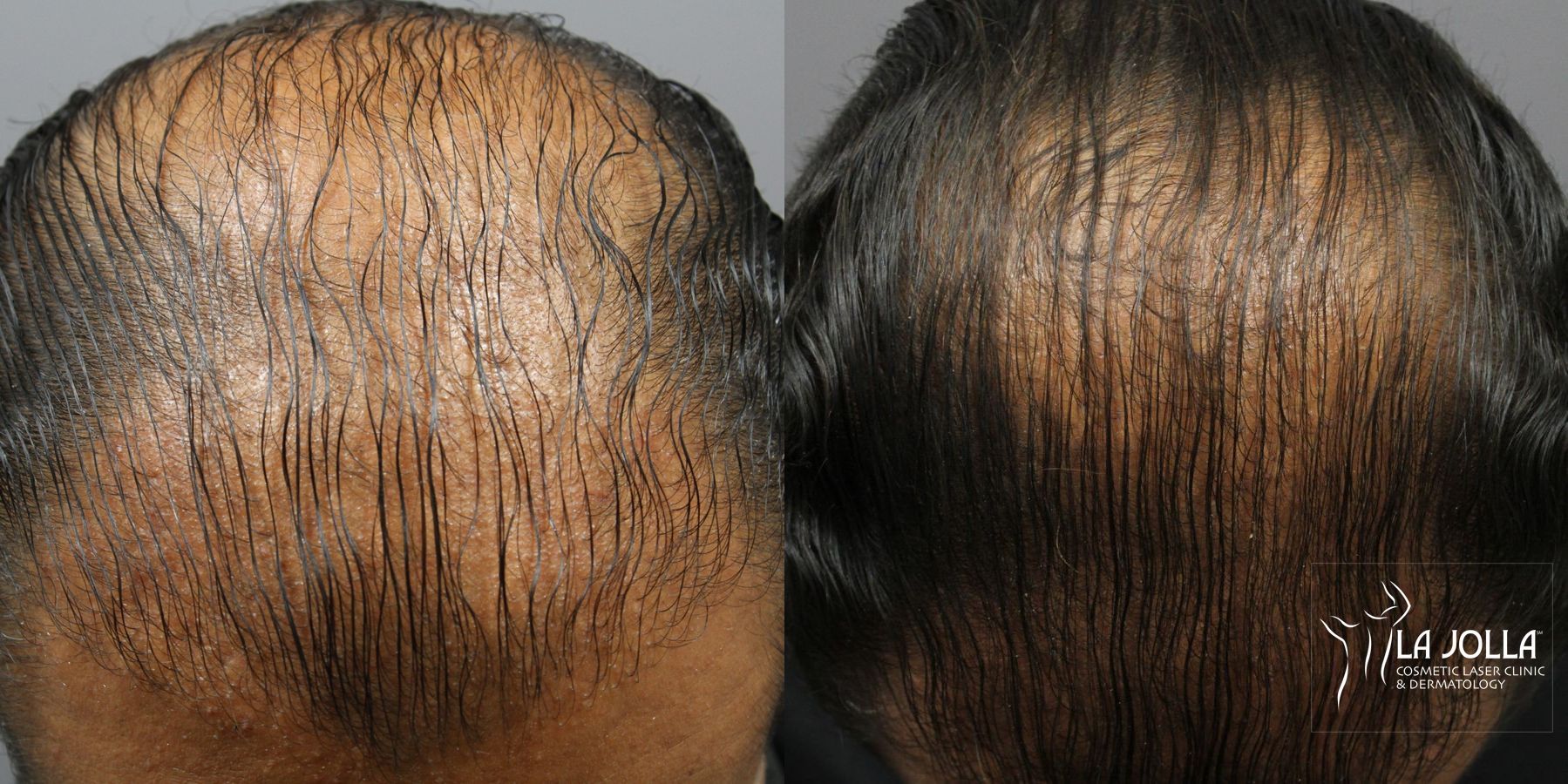 Before and after Regenerative Medicine case 36198