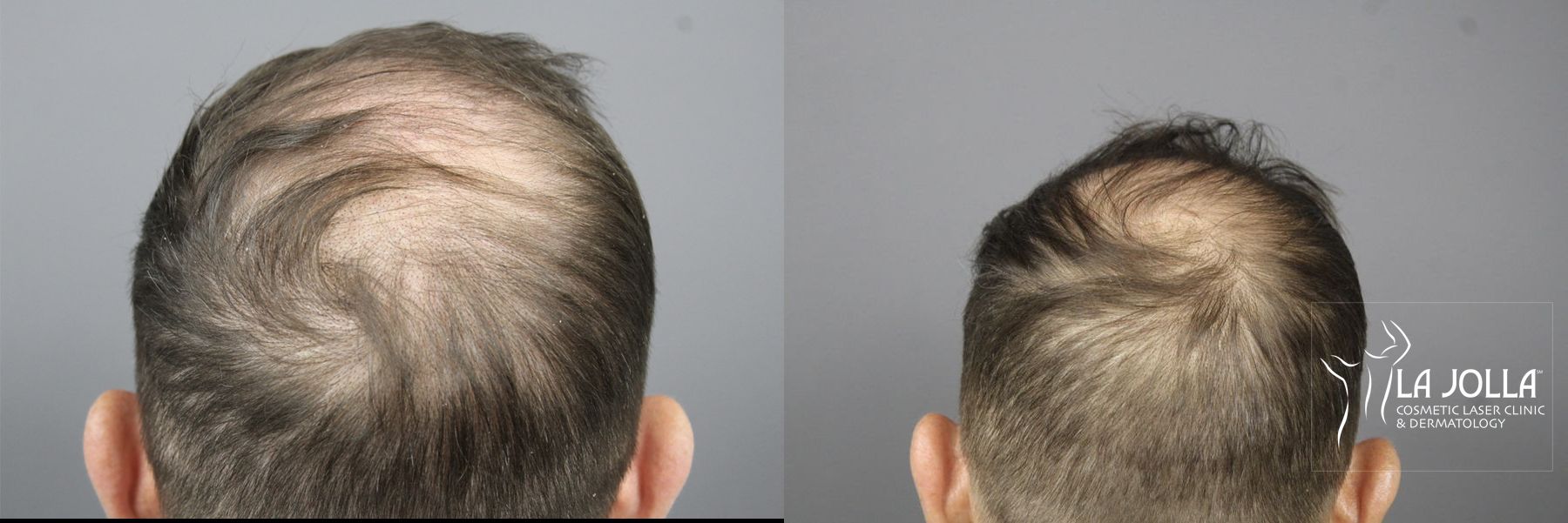 Before and after Regenerative Medicine case 36106