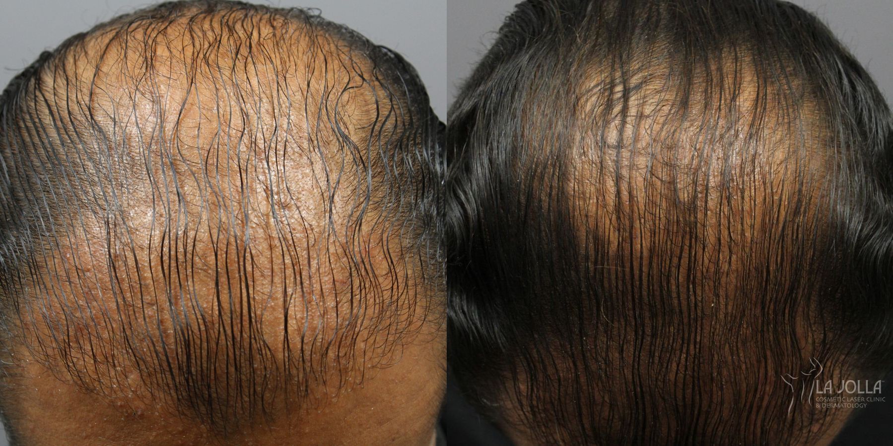 Before and after Regenerative Medicine case 36198