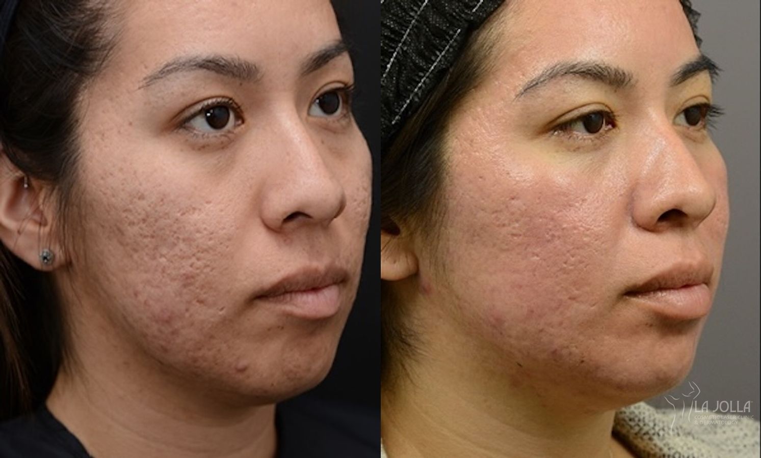 Before and after ResurFX case 36269