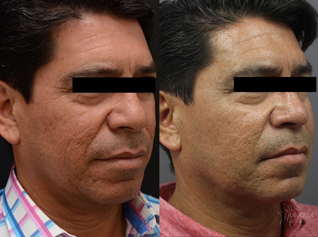 Before and after ResurFX case 36096 - Angle 3