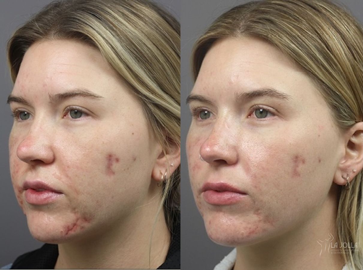 Before and after ResurFX case 36133 - Angle 2