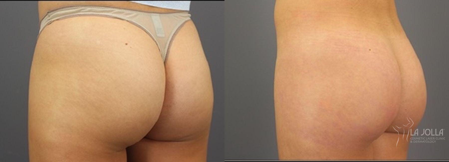 Before and after ResurFX case 36185