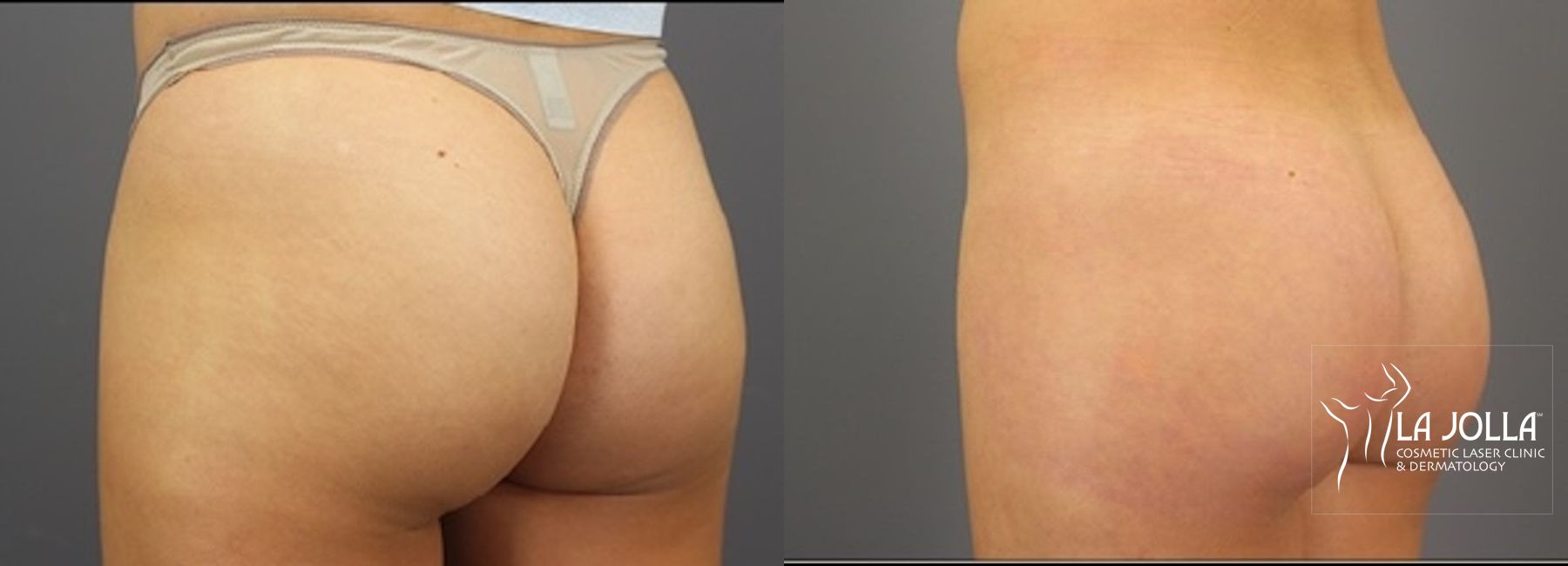 Before and after ResurFX case 36185
