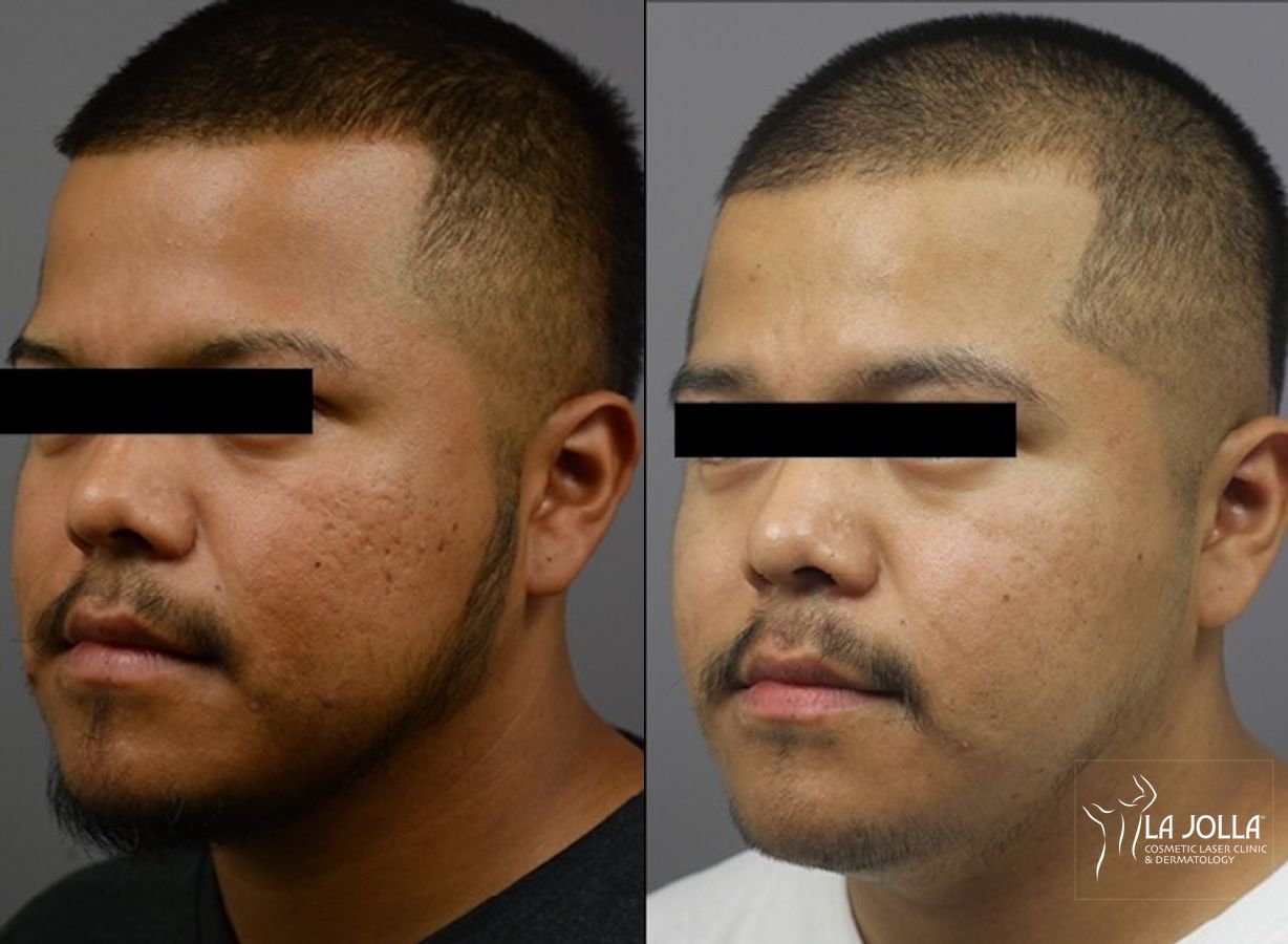 Before and after ResurFX case 36145