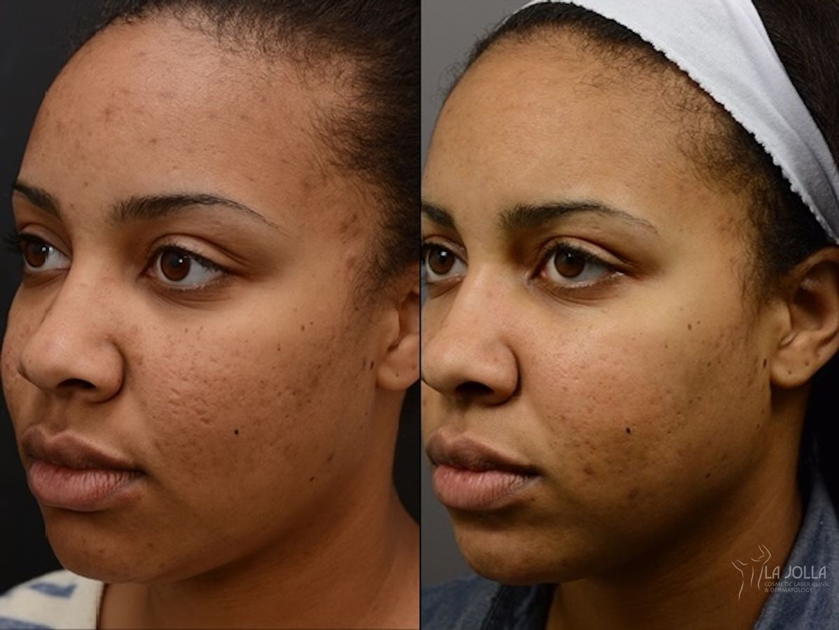 Before and after ResurFX case 36248