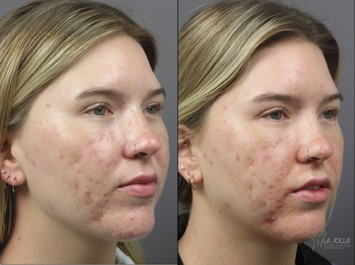 Before and after ResurFX case 36133 - Angle 3