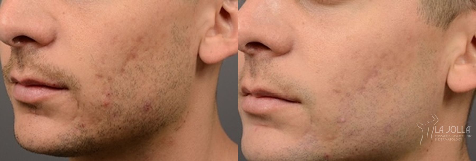 Before and after ResurFX case 36267
