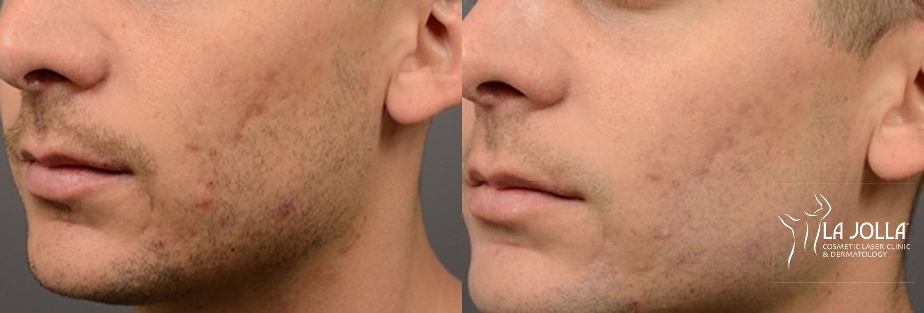 Before and after ResurFX case 36267